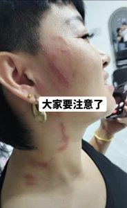 ​河北多地发现隐翅虫,落到身上千万不要拍,你得这样做……