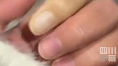 ​女生手指被冻白，医生称疑似“雷诺现象”