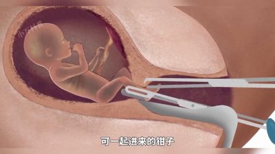 ​堕胎手术到底有多可怕？