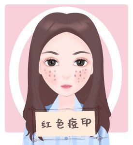 脸上痘印怎么最快淡化